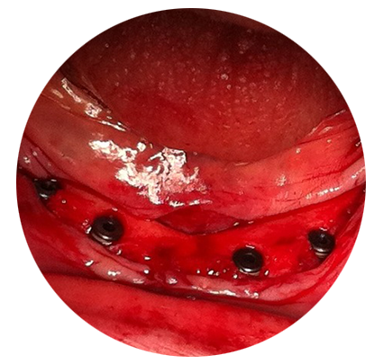 Имплантация зубов и протеза