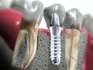 Имплантация имплант Система Astra Tech в стоматологии в Москве